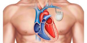 تطوير مصدر طاقة "أبدي" لجهاز تنظيم ضربات القلب