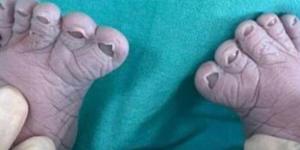 للمرة الثالثة.. امرأة تنجب طفلًا بـ12 إصبعًا في قدميه